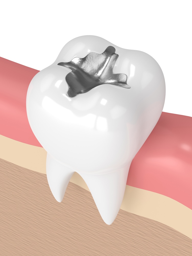 3d render of tooth with dental amalgam filling in gums
