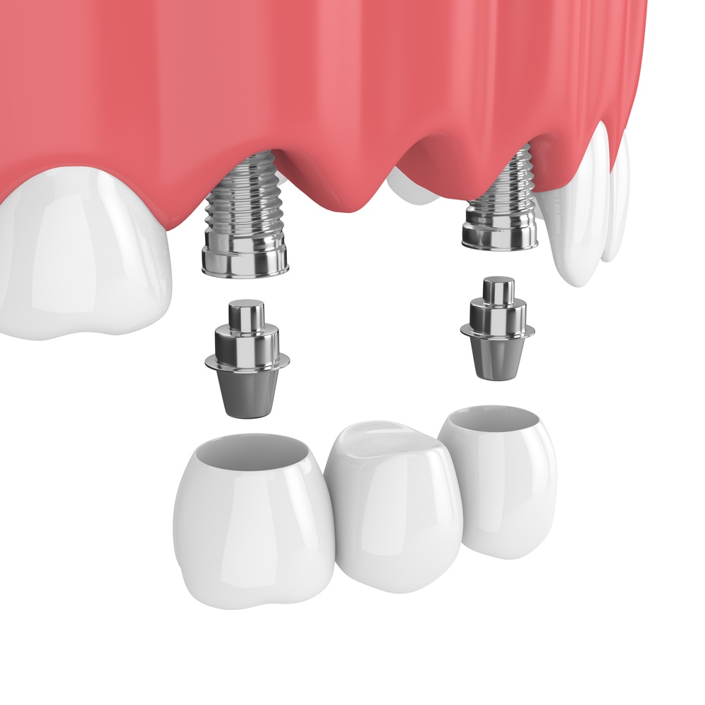 3d render of implants with dental bridge in upper jaw  isolated over white background