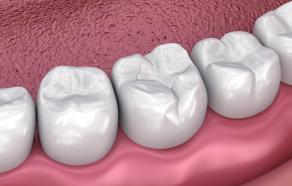 Fissure dental fillings, Medically accurate 3D illustration