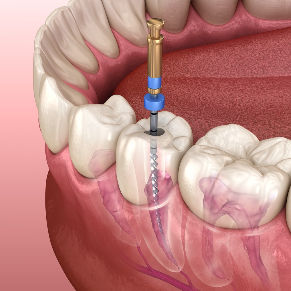 Endodontic root canal treatment process. Medically accurate tooth 3D illustration.