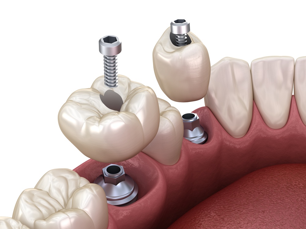 Premolar and Molar tooth crown installation over implant, screw fixation. 3D illustration of dental treatment