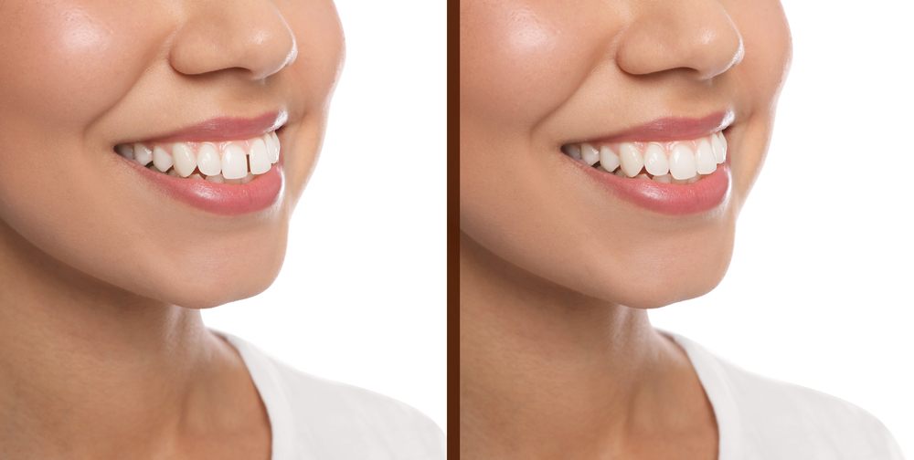 Collage with photos of woman with diastema between upper front teeth before and after treatment on white background, closeup. Banner design